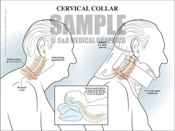 Cervical Injury Stabilization S A Medical Graphics