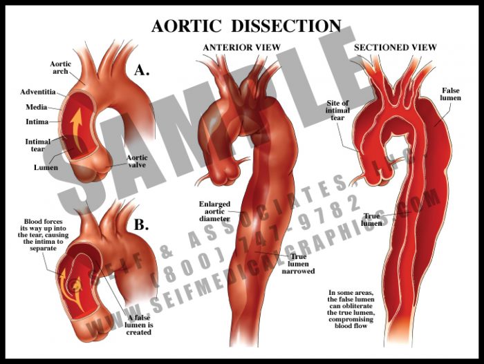 Medical Illustration of Aortic Dissection