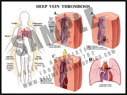 Medical Illustration of Deep Vein Thrombosis