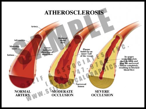 Medical Illustration of Atherosclerosis