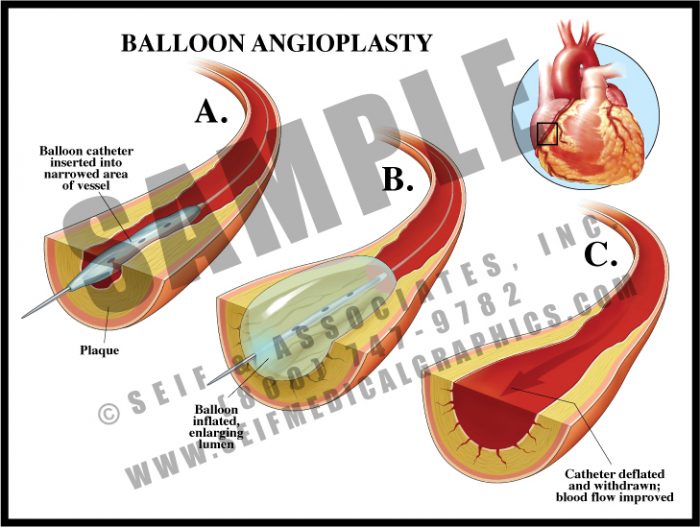 Medical Illustration of Balloon Angioplasty