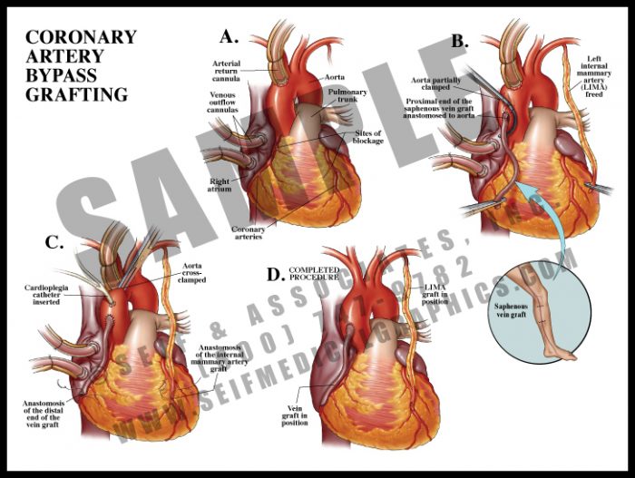 Medical Illustration of Coronary Artery Bypass Grafting