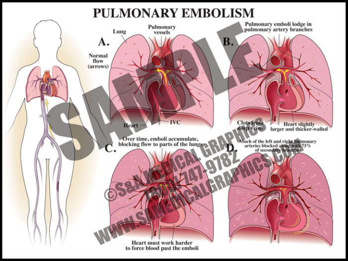 Medical Illustration of Pulmonary Embolism