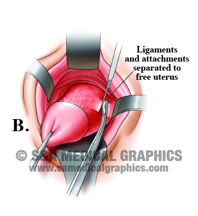 Medical Illustration Hysterectomy Step B