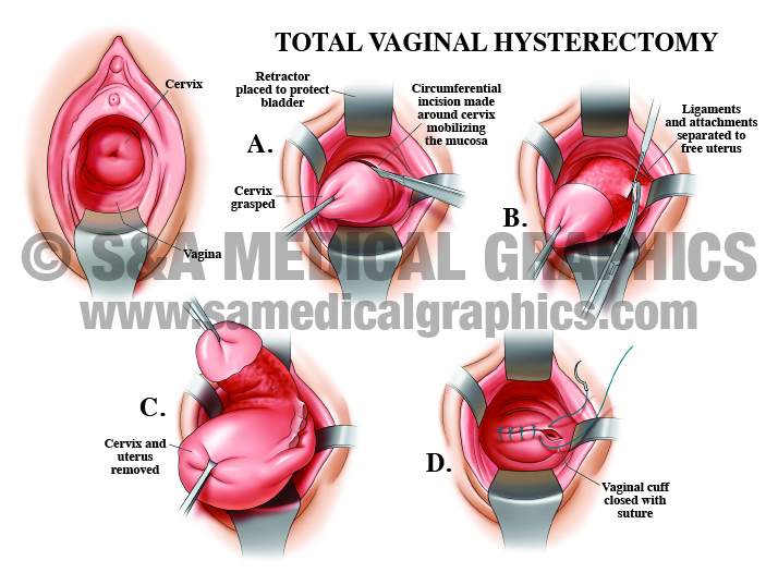 Medical Illustration surgical procedure of total vaginal hysterectomy