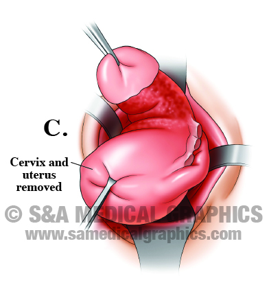 Medical Illustration Hysterectomy Step C