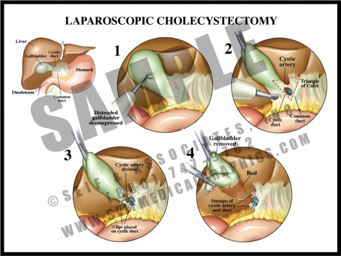 Medical Illustration of Laparoscopic Cholecystectomy Procedure