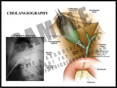 Medical Illustration of Cholangiography