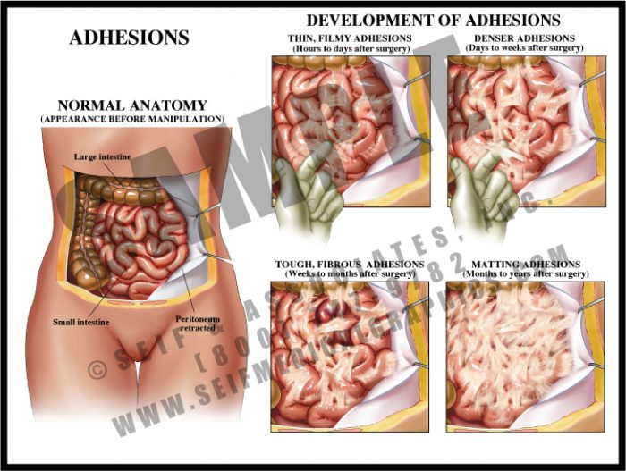 Medical Illustration of Adhesions