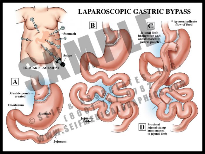 Medical Illustration of Laparoscopic Gastric Bypass