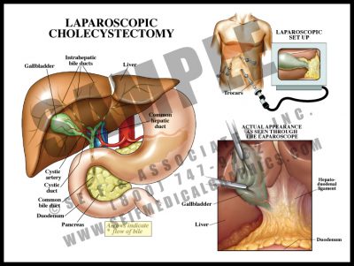 Ileus - S&A Medical Graphics