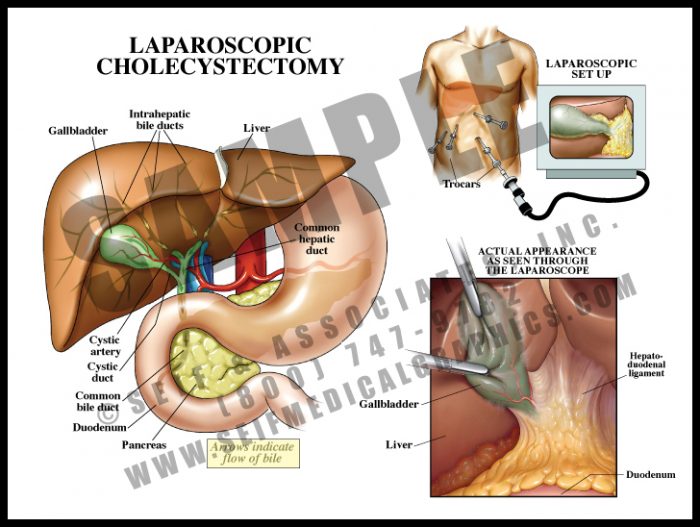 Medical Illustration of Laparoscopic Cholecystectomy Surgical Setup