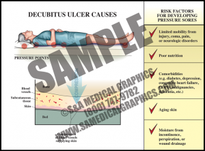 Decubitus Ulcer Formation - S&a Medical Graphics