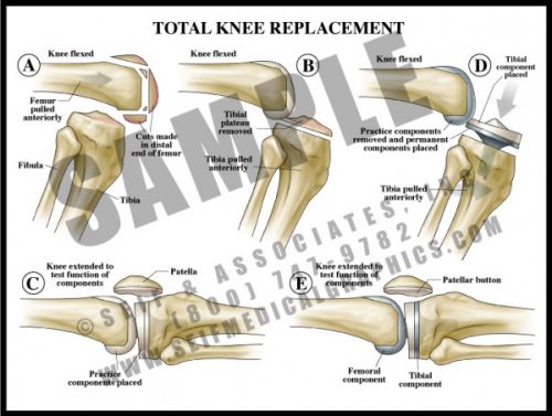 Medical Illustration of Total Knee Replacement