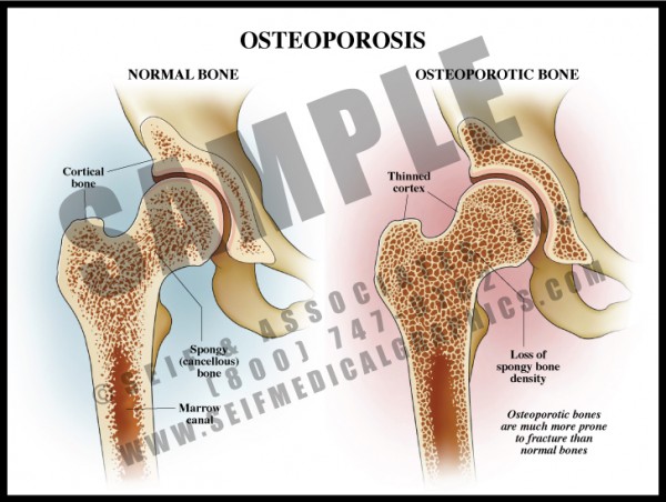 Medical Illustration of Osteoporosis