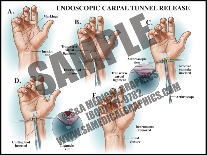 Medical Illustration of Endoscopic Carpal Tunnel Release
