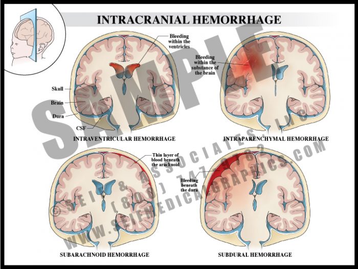 Medical Illustration of Intracranial Hemorrhage