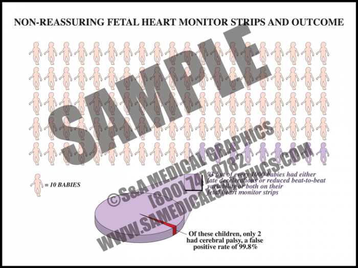 Medical Illustration of Non-reassuring Fetal Heart Monitor Strips and Outcome