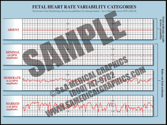 Medical Illustration of Fetal Heart Rate Variability Categories