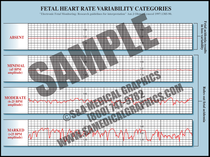 FHR Variability Categories S A Medical Graphics