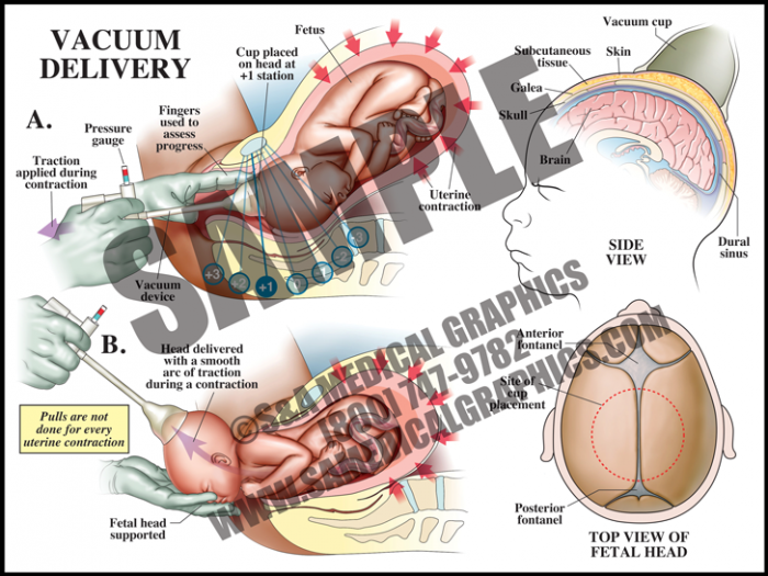 Medical Illustration of Vacuum Delivery