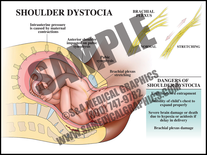 Medical Illustration of Shoulder Dystocia