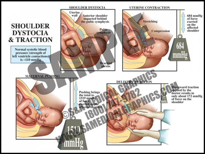Medical Illustration of Shoulder Dystocia and Traction