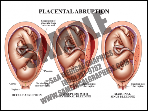 Medical Illustration of Placental Abruption