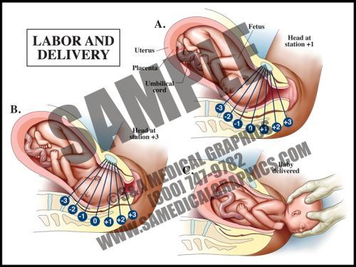Medical Illustration of Labor and Delivery