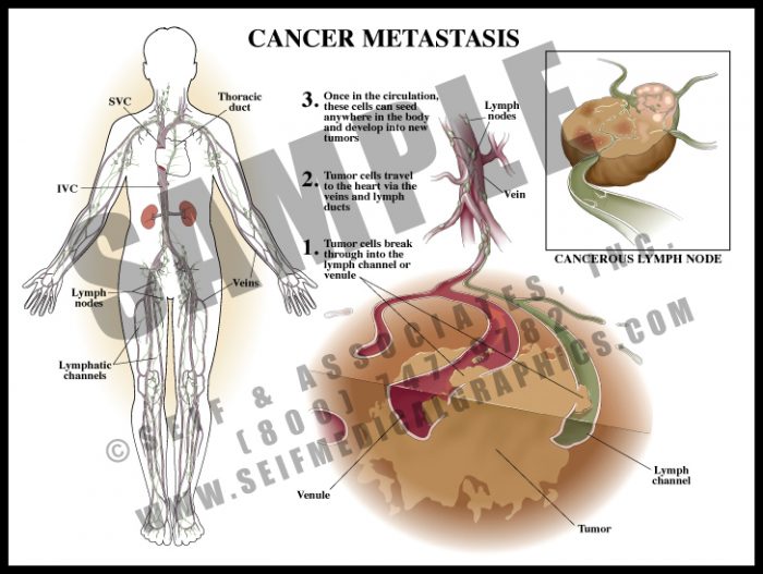 Medical Illustration of Cancer Metastasis