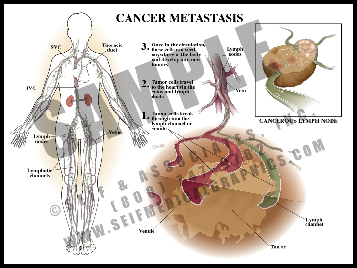 Cancer Metastasis Sanda Medical Graphics