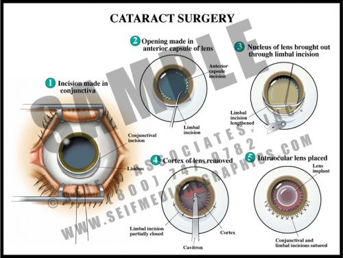 Medical Illustration of Cataract Surgery