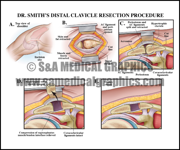 Custom Medical Legal Illustration of Distal Clavicle Resection Procedure Sample