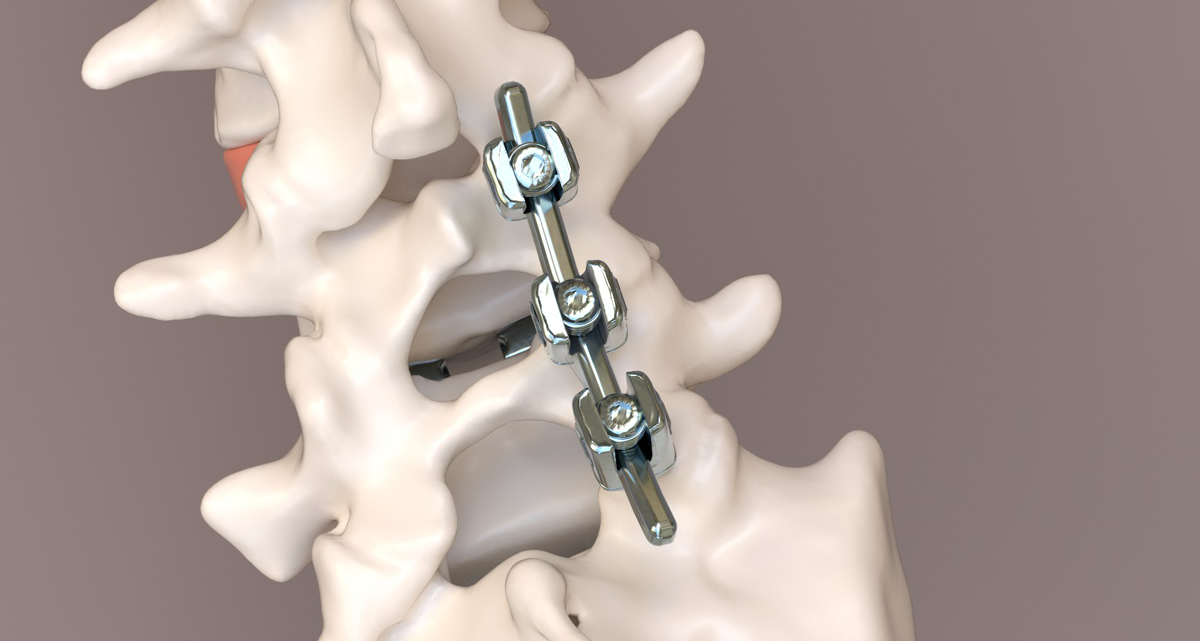 Accurate 3D Render of Patient's Spine From DICOM Films