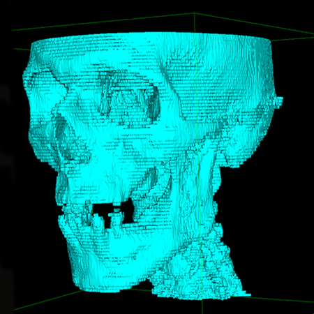 DICOM Reconstruction of Patient's Skull and Brain 3D Model