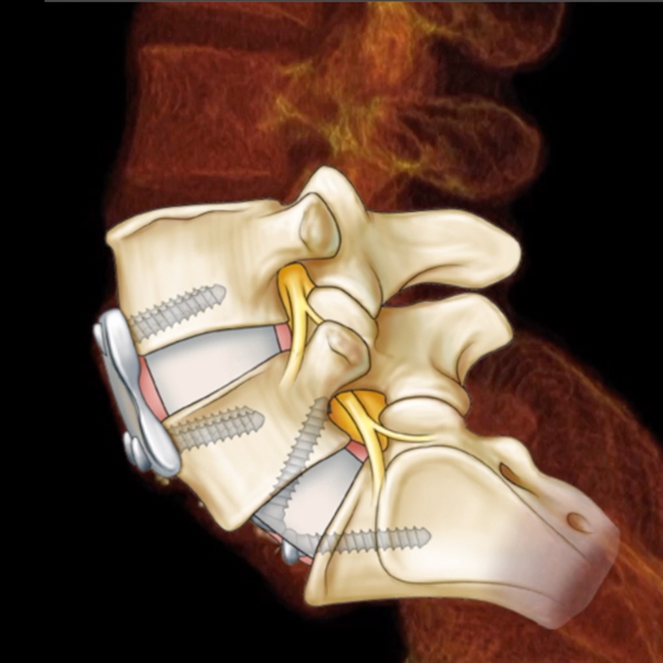 Spine Radiology Reconstruction With Medical Illustration Overlay