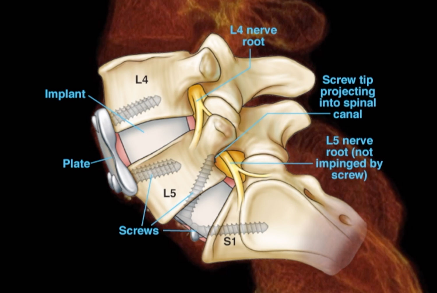 Illustration overlay on spine radiology film