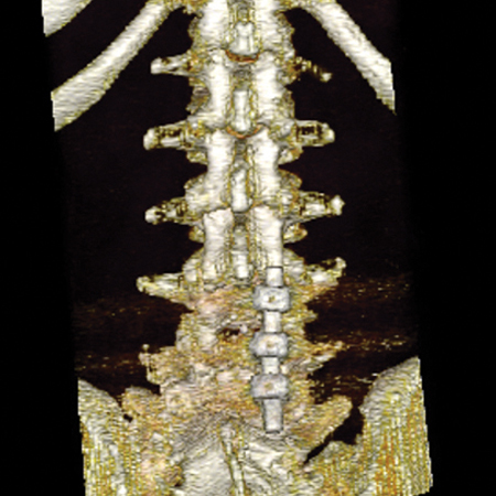3D digital spine radiology reconstruction