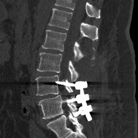 Spine Radiology Film