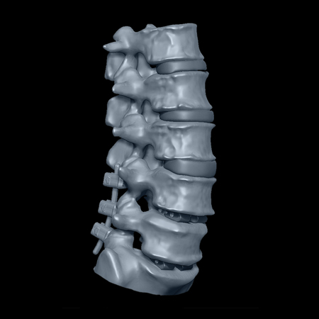 3D Digital Model Reconstruction of Spine