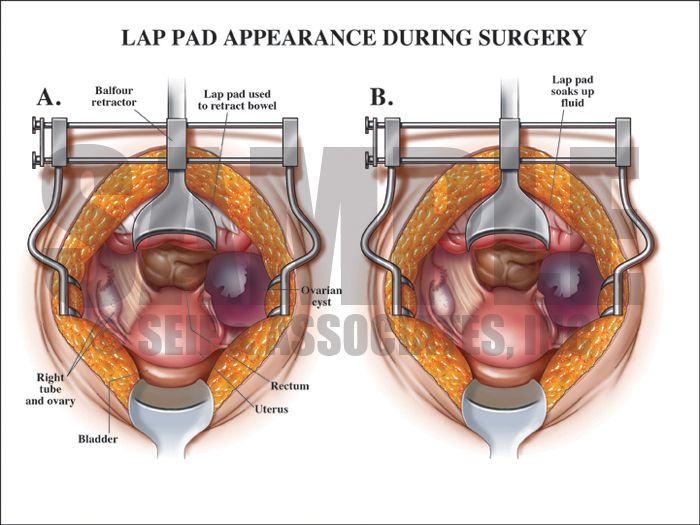 Lap Pad During Surgery Medical Illustration