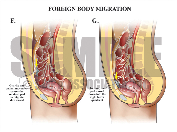 Retained Foreign Body Migration