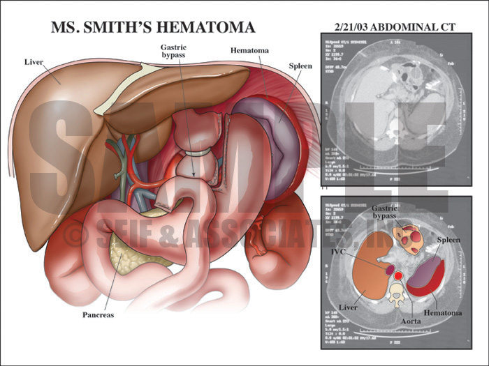 Hematoma Medical Illustration