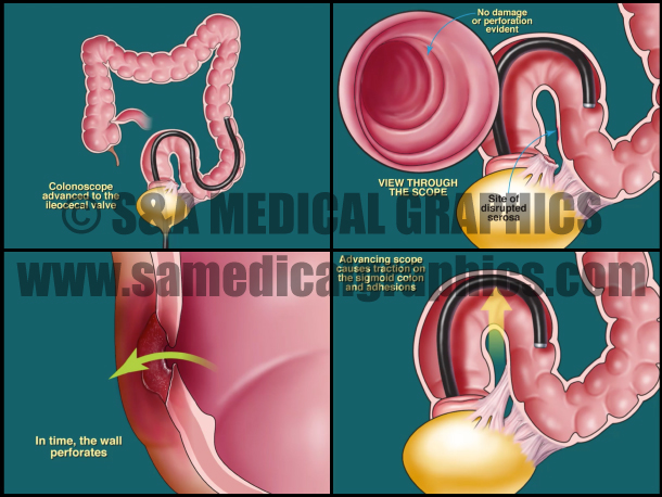 Abdominopelvic surgery colonoscopy animation
