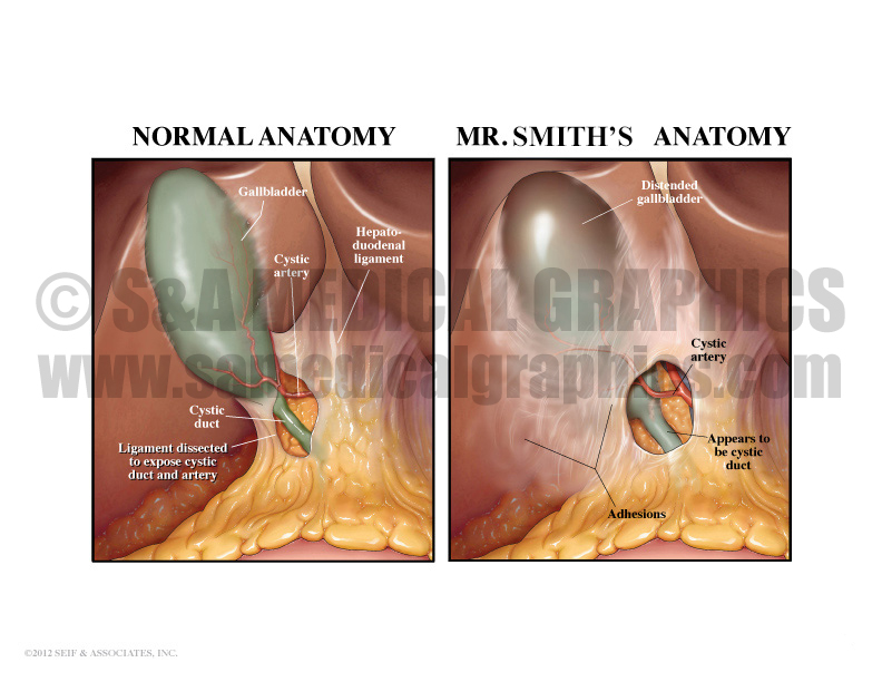 Gallbladder Bile Duct Medical Illustration