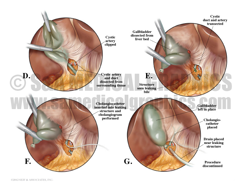 Cholecystectomy Procedure Medical Illustration
