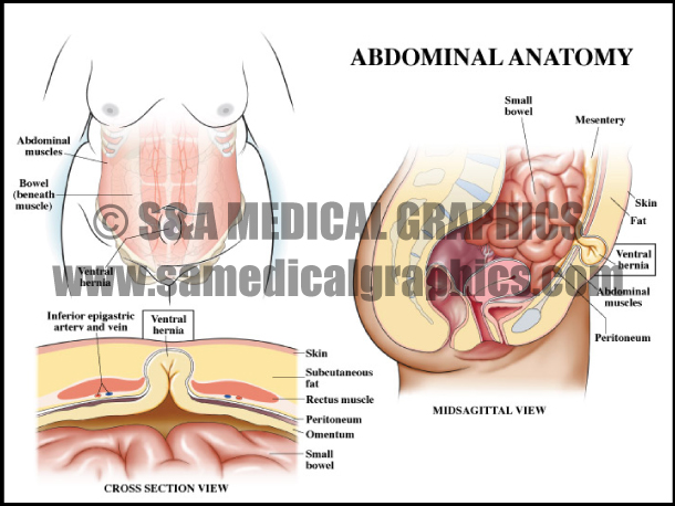 Abdominopelvic Surgery Hernia Abdominal Anatomy