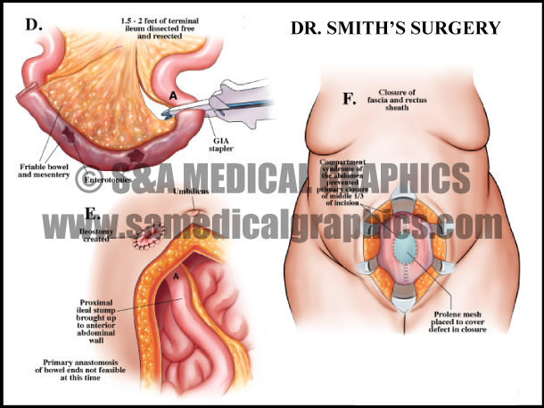 Abdominopelvic Surgery