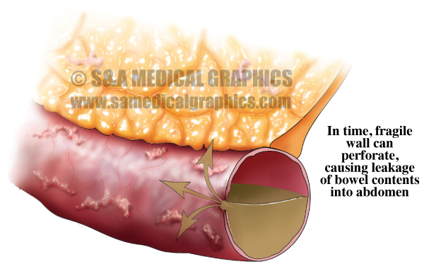 Bowel Perforation Adhesions Medical Illustration