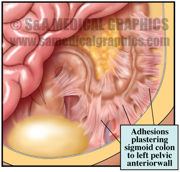 Adhesions Medical Illustration